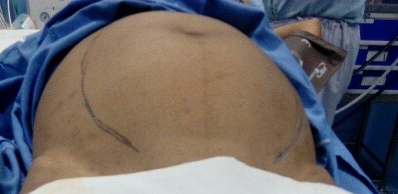 laparoscopy surgery in indore