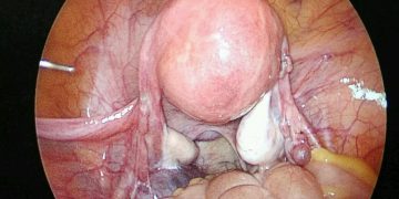 laparoscopic hysterectomy in indore