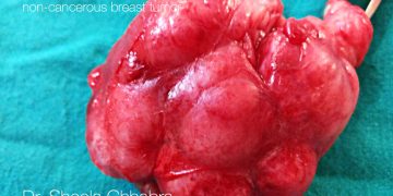 breast tumor surgery in indore