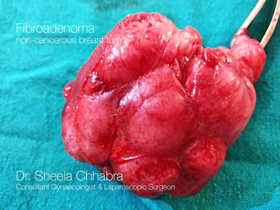 breast tumor surgery in indore