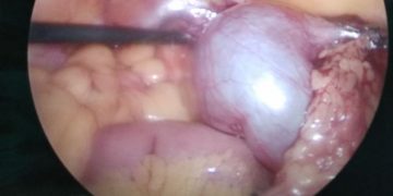 ovarian cyst surgery