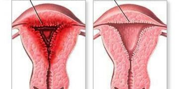 heavy periods treatment in indore