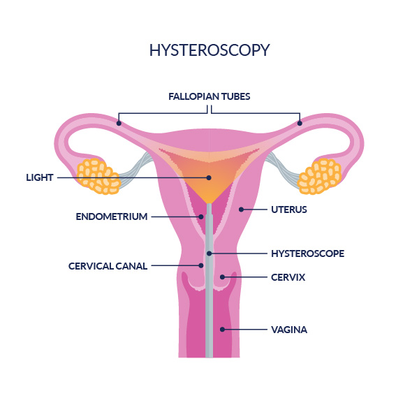 best hysteroscopy services in Indore