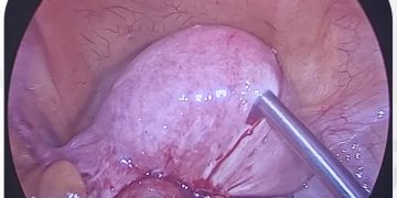 total laparoscopic hysterectomy