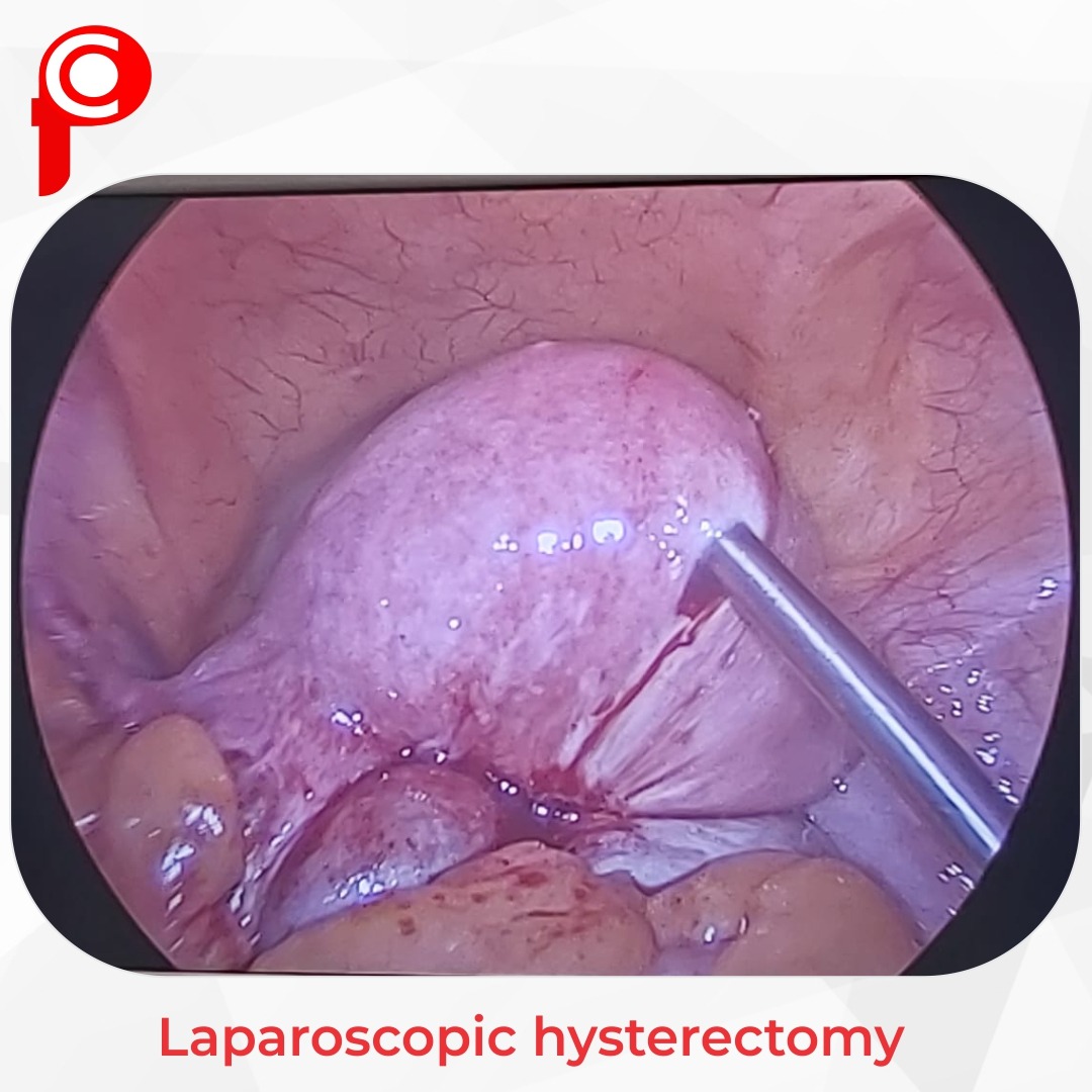 total laparoscopic hysterectomy